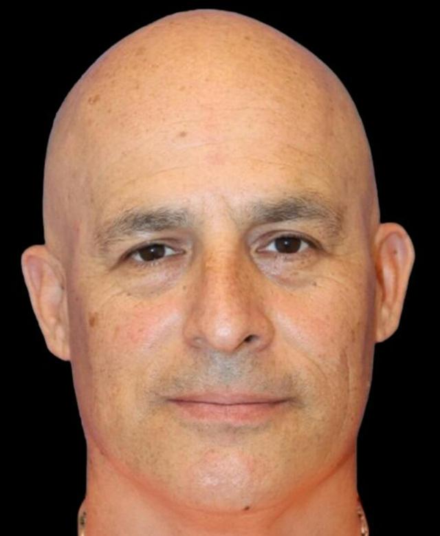 Blepharoplasty before at Dr. Kristy Hamilton in Houston, TX