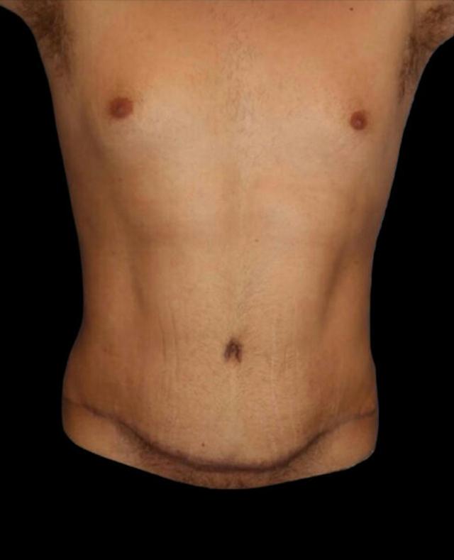 Mini Tummy Tuck after at Dr. Kristy Hamilton in Houston, TX