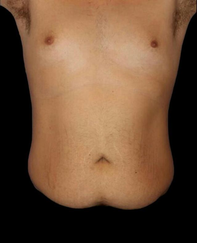 Mini Tummy Tuck before at Dr. Kristy Hamilton in Houston, TX