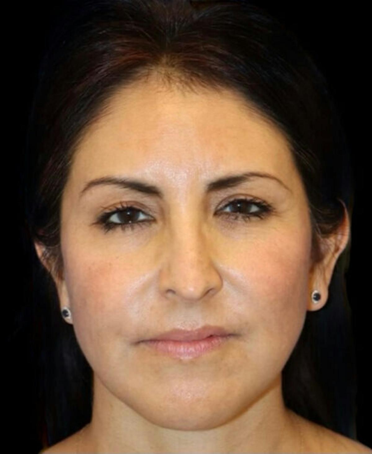 Dr. Kristy Hamilton facelift after — Houston, TX