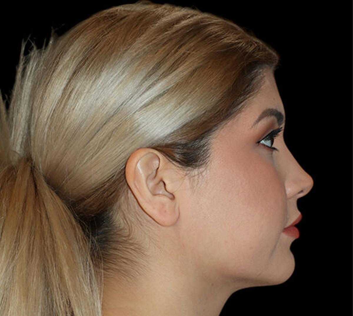 Dr. Kristy Hamilton submental liposuction after — Houston, TX
