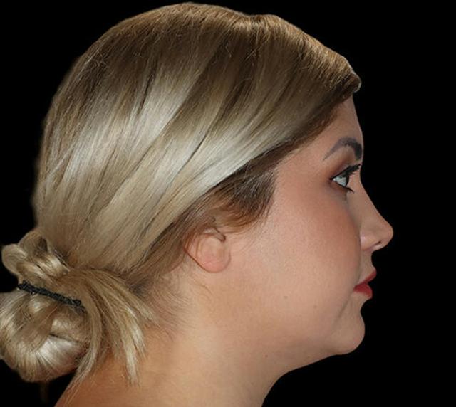 Neck Liposuction before at Dr. Kristy Hamilton in Houston, TX