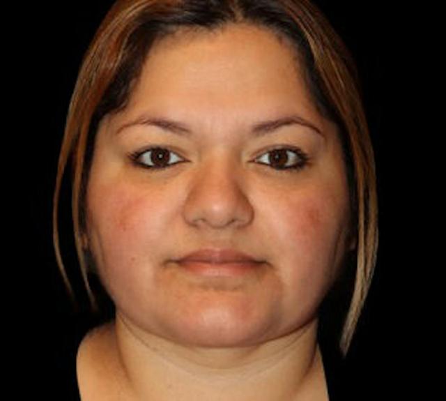 Neck Liposuction after at Dr. Kristy Hamilton in Houston, TX