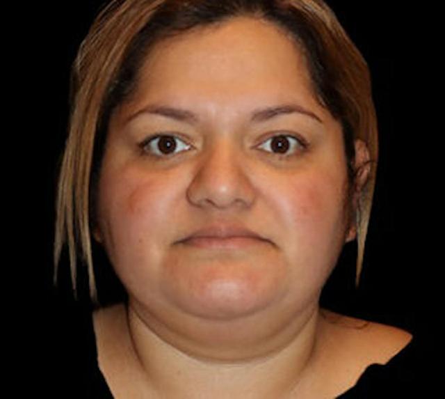 Neck Liposuction before at Dr. Kristy Hamilton in Houston, TX