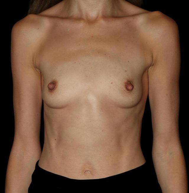 Breast Augmentation before at Dr. Kristy Hamilton in Houston, TX