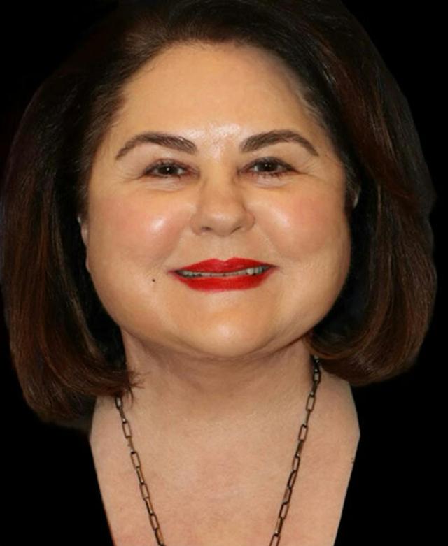 Neck Lift after at Dr. Kristy Hamilton in Houston, TX