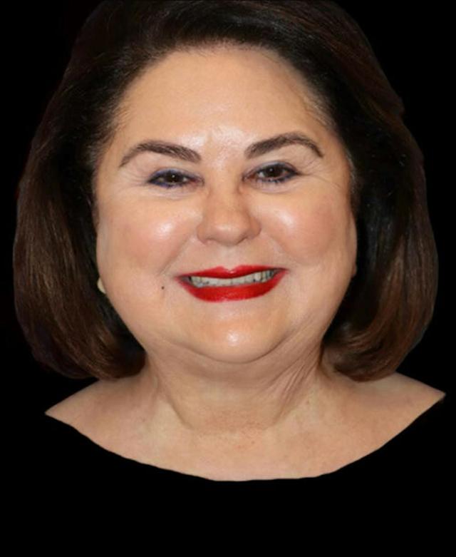 Neck Lift before at Dr. Kristy Hamilton in Houston, TX
