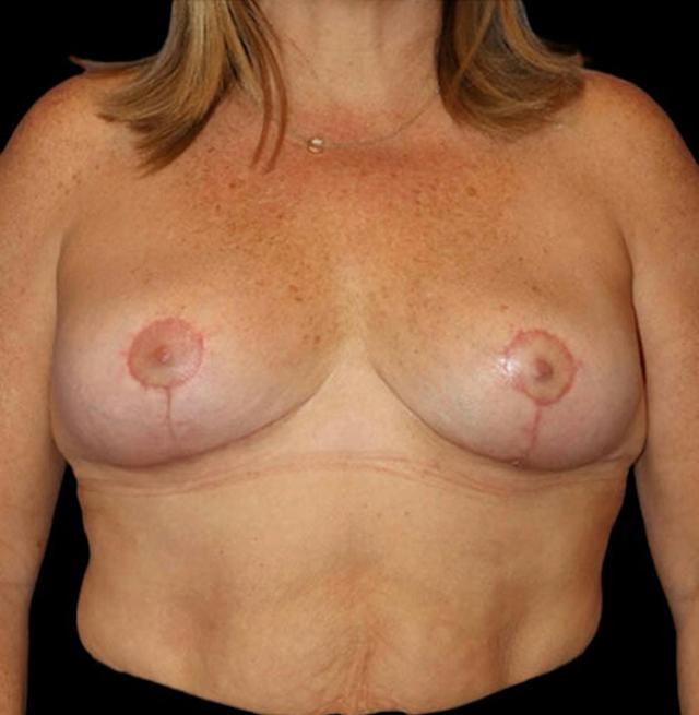 Breast Lift after at Dr. Kristy Hamilton in Houston, TX