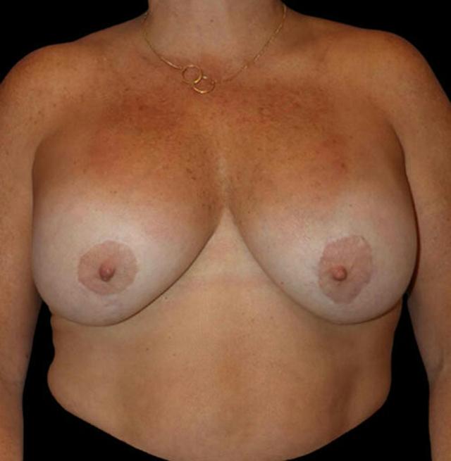 Breast Lift before at Dr. Kristy Hamilton in Houston, TX