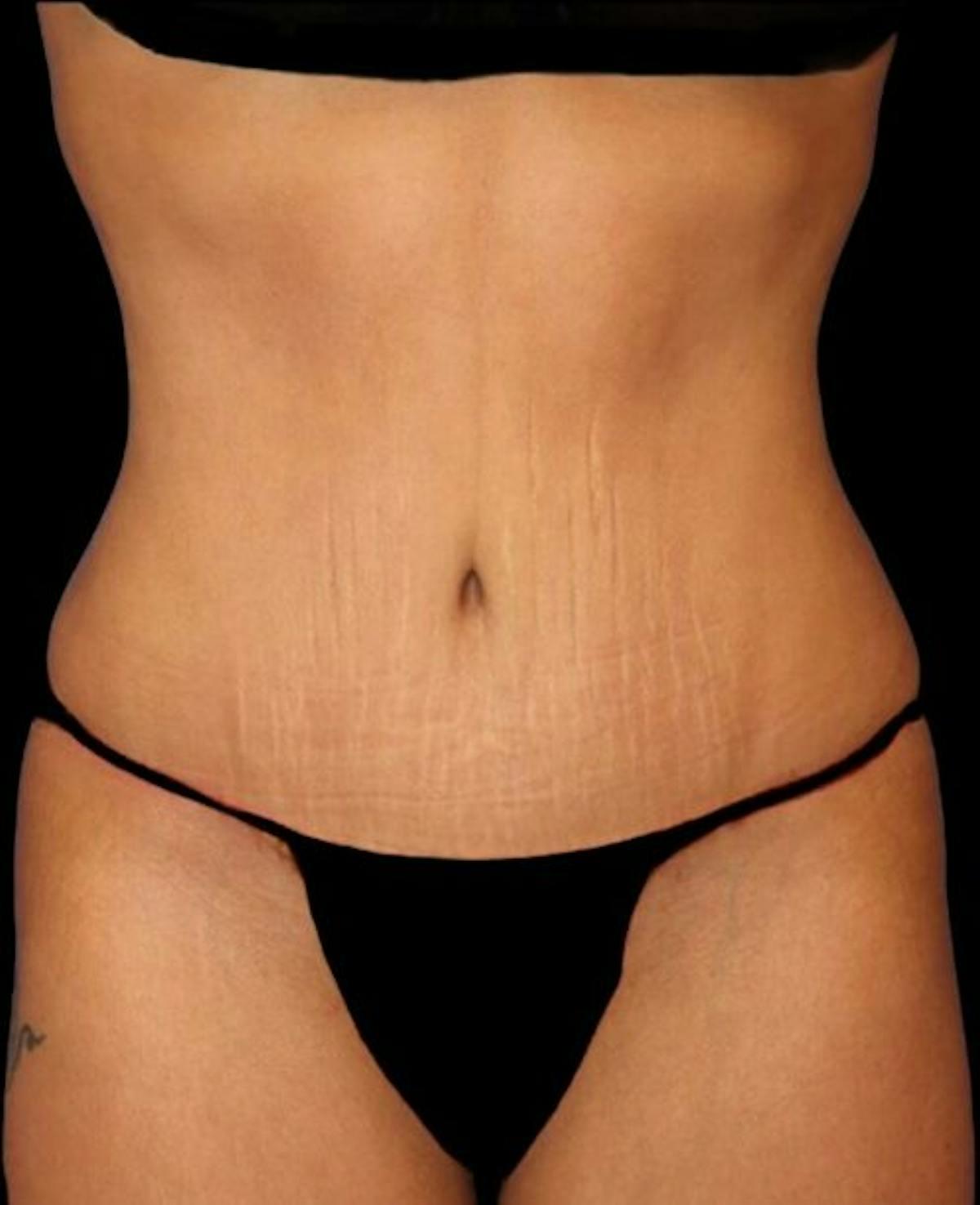 Dr. Kristy Hamilton tummy tuck after — Houston, TX
