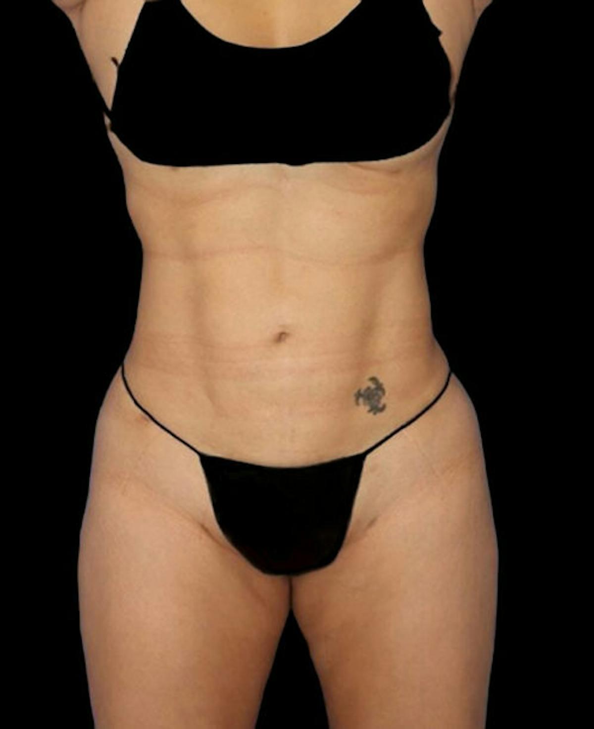 Dr. Kristy Hamilton liposuction after — Houston, TX
