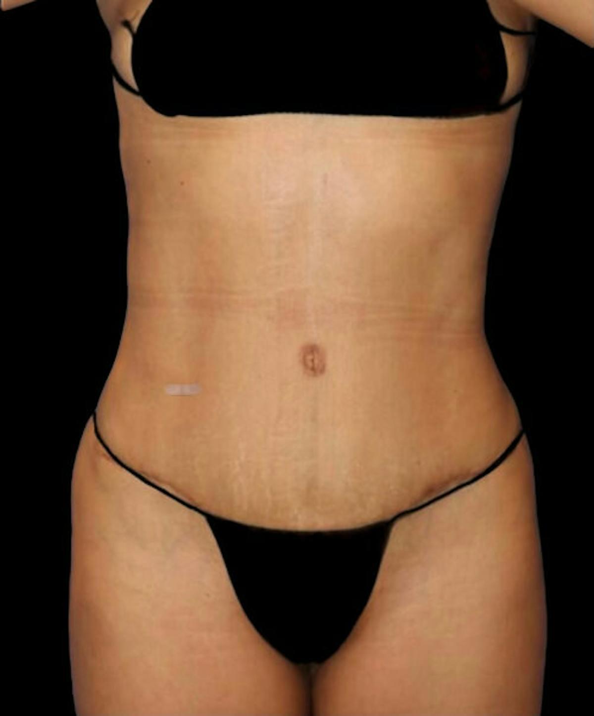 Dr. Kristy Hamilton tummy tuck after — Houston, TX