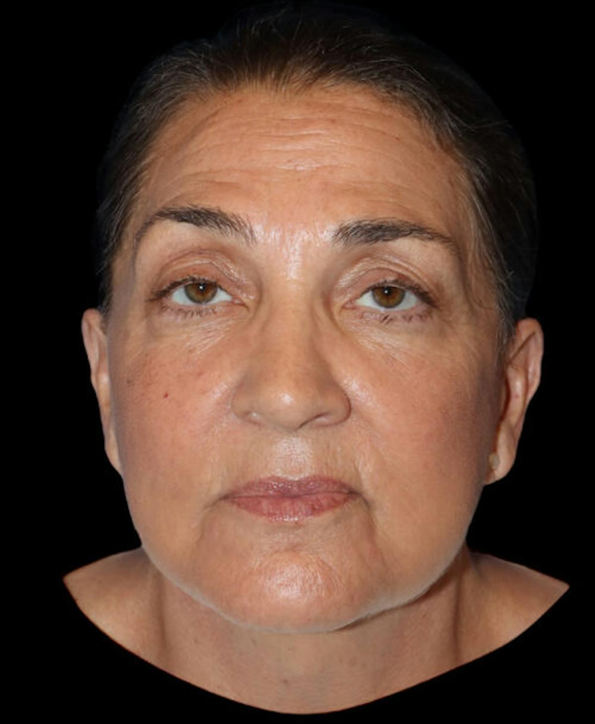 Dr. Kristy Hamilton facelift after — Houston, TX