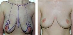 Dr. Stuart Linder breast lift result — Beverly Hills, CA