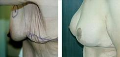 Dr. Stuart Linder breast lift result — Beverly Hills, CA