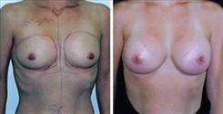 Breast Augmentation result at Dr. Stuart Linder in Beverly Hills, CA