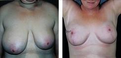 Dr. Stuart Linder breast reduction result — Beverly Hills, CA