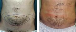 Liposuction result at Dr. Stuart Linder in Beverly Hills, CA