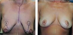 Dr. Stuart Linder breast lift result — Beverly Hills, CA