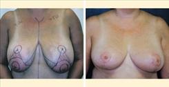 Breast Reduction result at Dr. Stuart Linder in Beverly Hills, CA