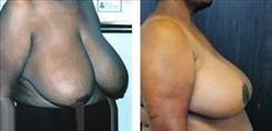 Dr. Stuart Linder breast reduction result — Beverly Hills, CA