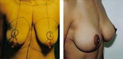 Breast Lift result at Dr. Stuart Linder in Beverly Hills, CA