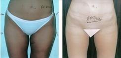 Liposuction result at Dr. Stuart Linder in Beverly Hills, CA