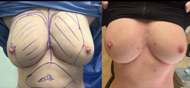 Fat Transfer result at Dr. Stuart Linder in Beverly Hills, CA