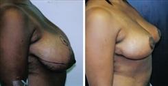 Breast Reduction result at Dr. Stuart Linder in Beverly Hills, CA