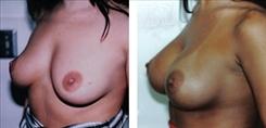 Breast Augmentation result at Dr. Stuart Linder in Beverly Hills, CA