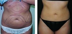 Dr. Stuart Linder liposuction result — Beverly Hills, CA
