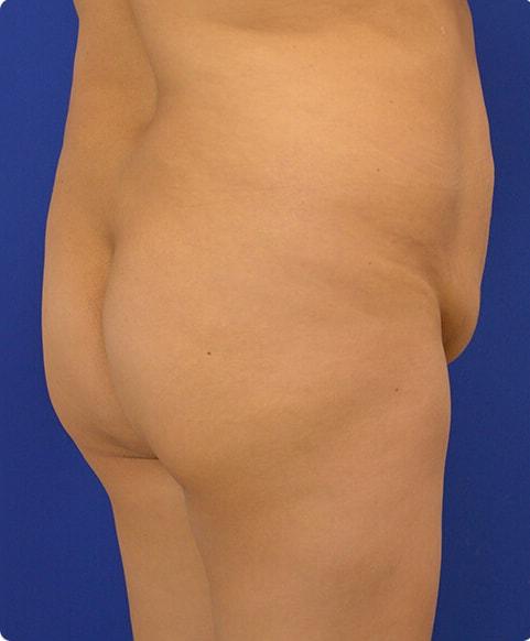 Brazilian Butt Lift before at Advanced Plastic Surgery in Grand Rapids, MI
