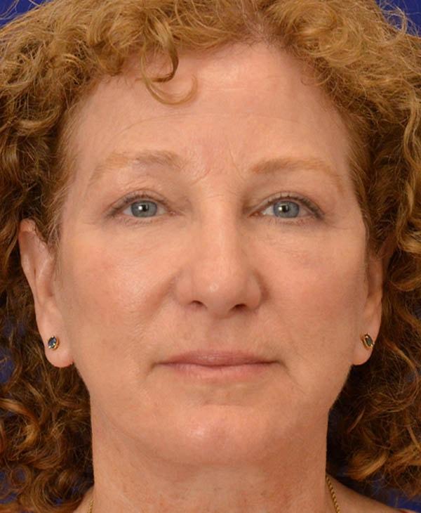 Facelift after at Advanced Plastic Surgery in Grand Rapids, MI