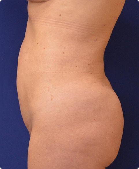 Brazilian Butt Lift after at Advanced Plastic Surgery in Grand Rapids, MI