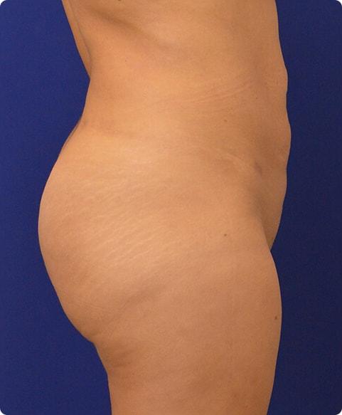 Advanced Plastic Surgery bbl after — Grand Rapids, MI