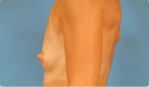 Breast Augmentation before at Advanced Plastic Surgery in Grand Rapids, MI