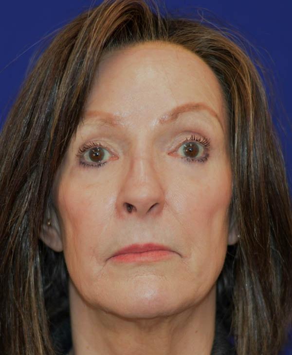 Advanced Plastic Surgery facelift after — Grand Rapids, MI