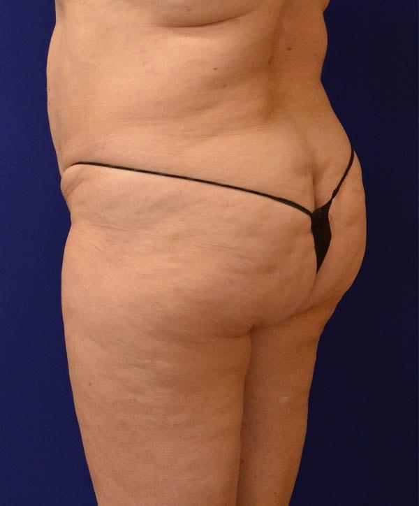 Brazilian Butt Lift before at Advanced Plastic Surgery in Grand Rapids, MI