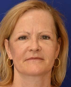 Advanced Plastic Surgery facelift after — Grand Rapids, MI