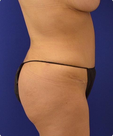 Liposuction after at Advanced Plastic Surgery in Grand Rapids, MI