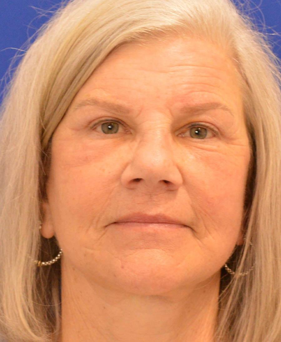 Advanced Plastic Surgery facelift after — Grand Rapids, MI