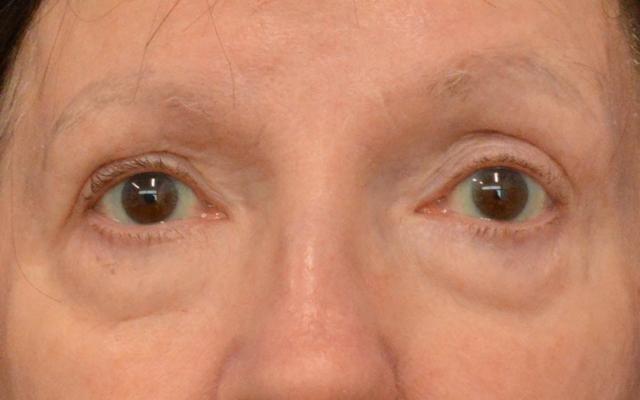 Blepharoplasty before at Advanced Plastic Surgery in Grand Rapids, MI
