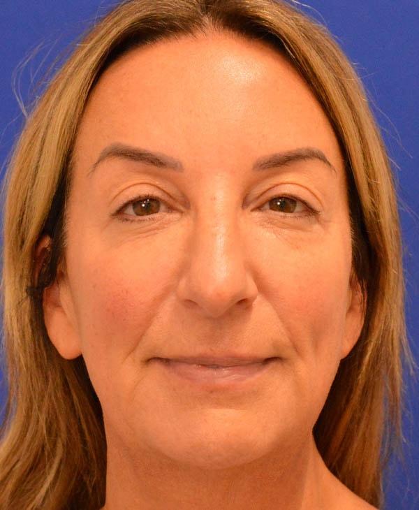 Facelift before at Advanced Plastic Surgery in Grand Rapids, MI
