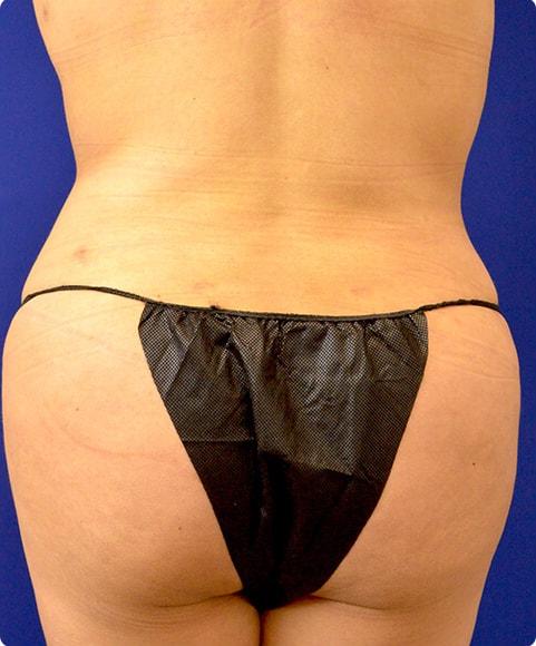 Liposuction after at Advanced Plastic Surgery in Grand Rapids, MI