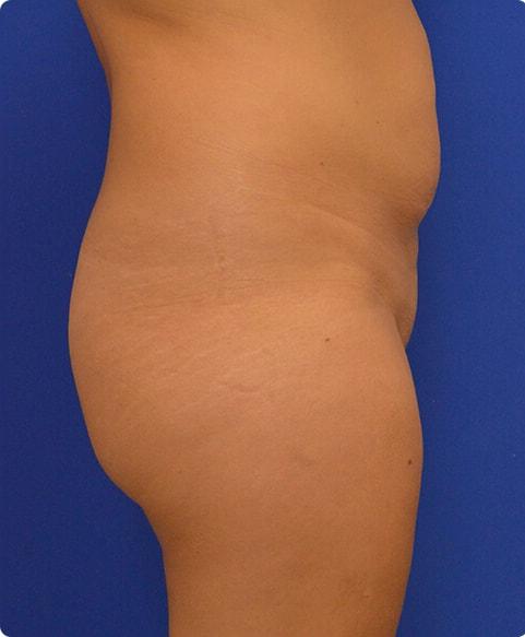 Brazilian Butt Lift before at Advanced Plastic Surgery in Grand Rapids, MI