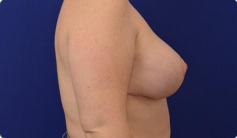 Breast Lift after at Advanced Plastic Surgery in Grand Rapids, MI