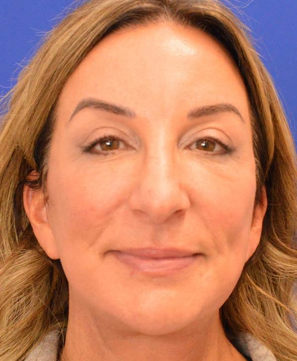 Advanced Plastic Surgery facelift after — Grand Rapids, MI