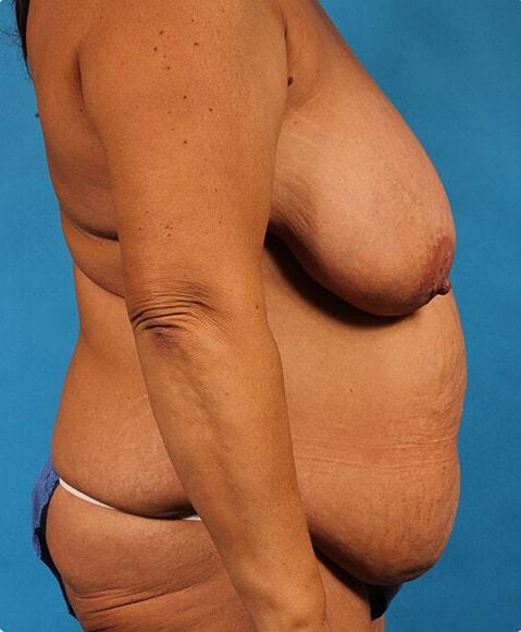 CoolSculpting before at Advanced Plastic Surgery in Grand Rapids, MI