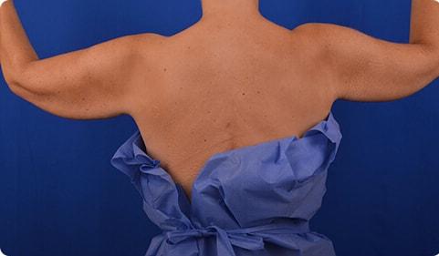 Arm Lift before at Advanced Plastic Surgery in Grand Rapids, MI
