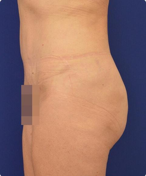 Advanced Plastic Surgery liposuction after — Grand Rapids, MI